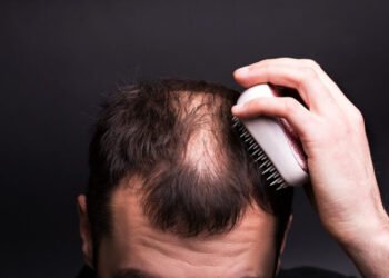 Trasplante capilar: riesgos y efectos secundarios más comunes