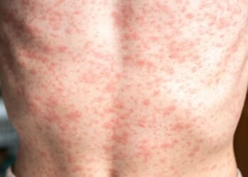 OPS prende las alarmas: Sarampión deja más de 11 mil contagios en América durante 2025