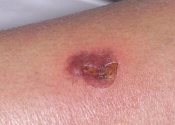 ¿Qué es la brasa, la infección de la que reportaron brotes en Delta Amacuro?