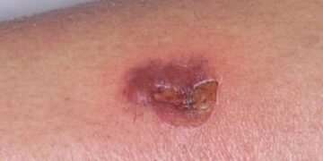 ¿Qué es la brasa, la infección de la que reportaron brotes en Delta Amacuro?